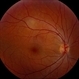 Unilateral Acute Idiopathic Maculopathy - Color Photo Unilateral Acute Idiopathic Maculopathy - Color Photo